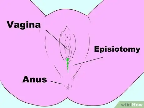 Image titled Prevent and Treat Postpartum Hemorrhage Step 8