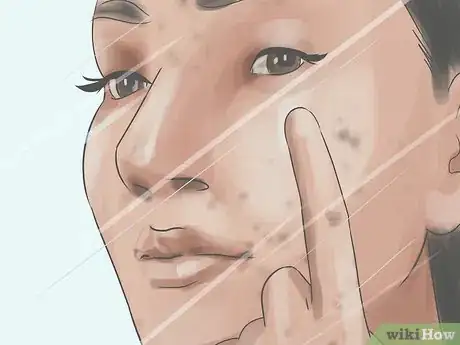 Image titled Stop Dermatillomania Step 5