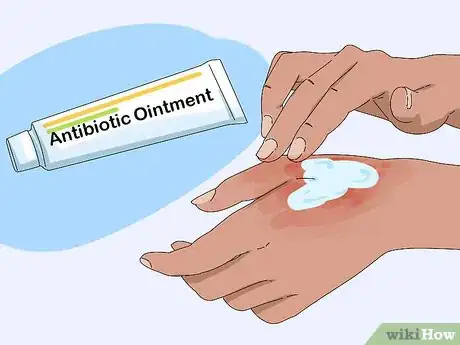 Image titled Prevent Milia Step 4