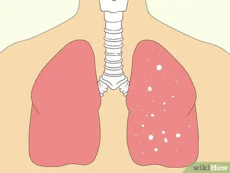 Image titled Treat Neurological Disorders Step 8