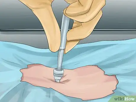 Image titled Diagnose Vitiligo Step 8