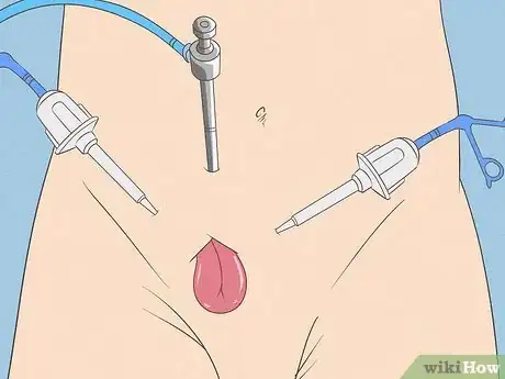 Image titled Treat Inguinal Hernia Step 11