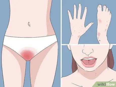 Image titled Diagnose a Yeast Infection at Home Step 3